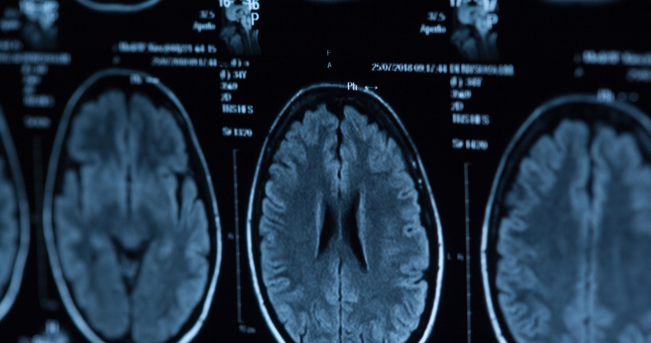 Odkryto istotne biologiczne różnice w mózgach psychopatów – nowe ustalenia naukowców